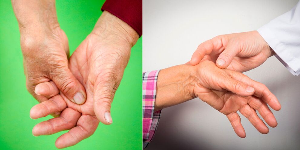 gydymas artrozės nuo pirštų rankų sąnarių liaudies gynimo priemones peptidai gydymas sąnarių