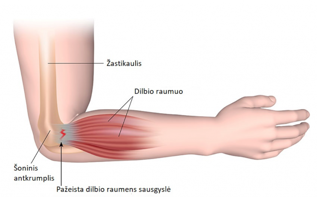 skauda rankos raumenis skausmas alkūnės sąnarius nuo žemiau
