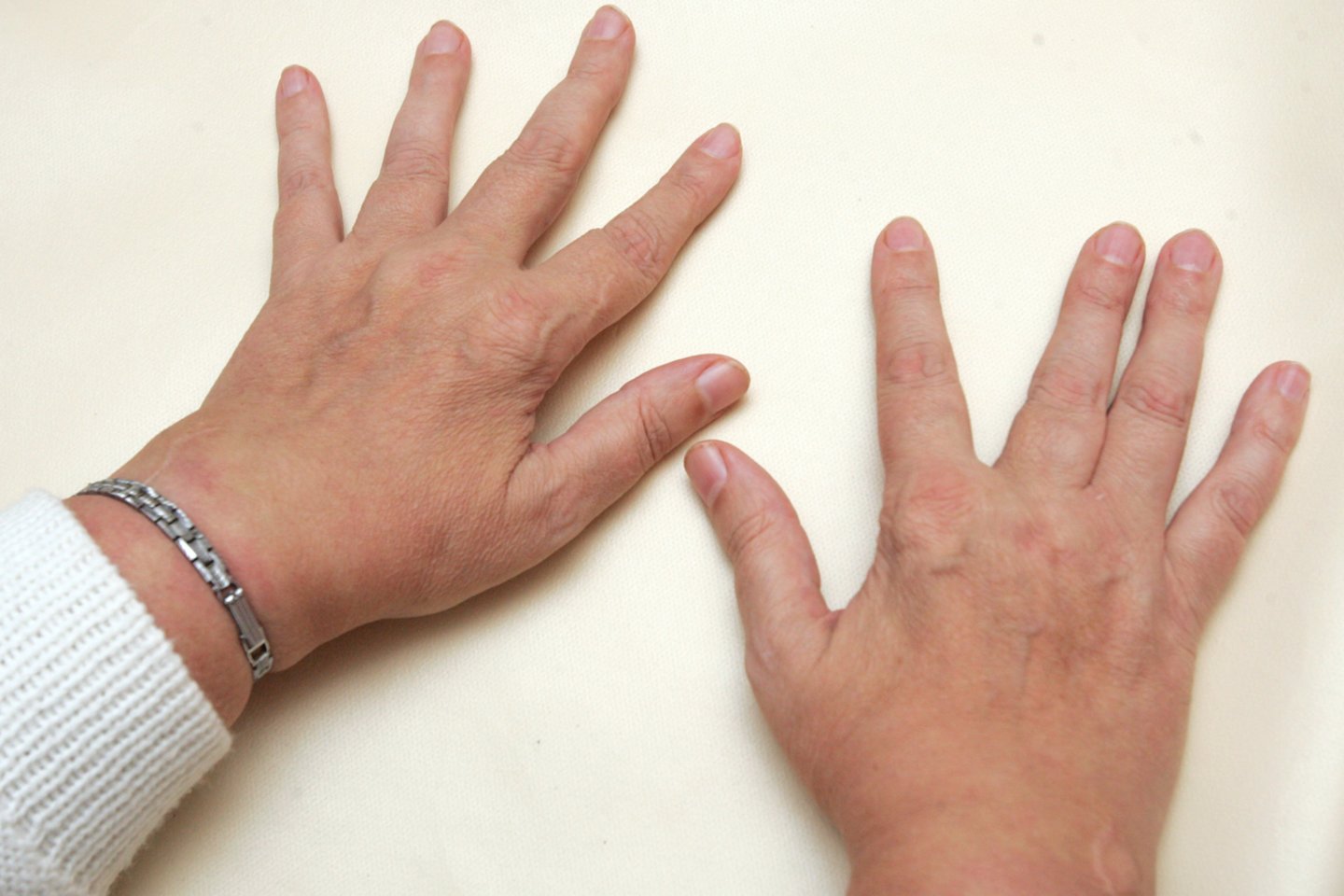 gliukozaminas ir chondroitina įvertinimas artrozė 2 etapai artimųjų kojų sąnarių