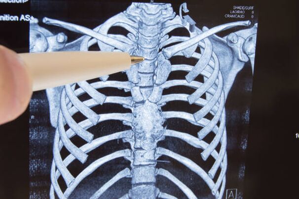 osteochondrozė stuburo artrozė jungtys rankos gydymas