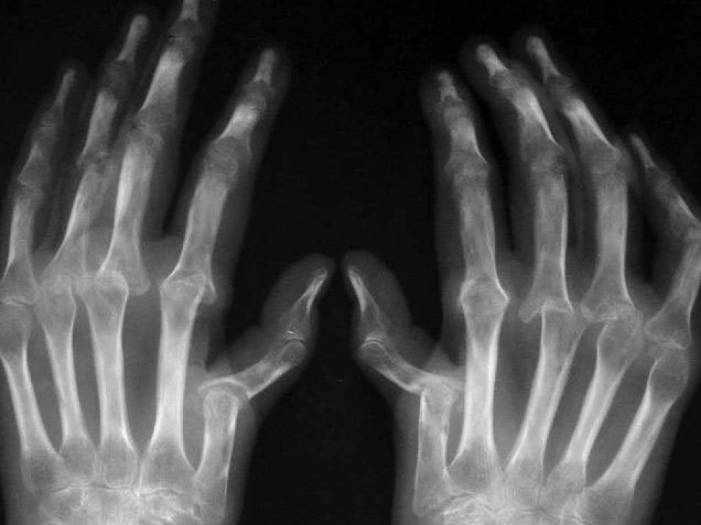 artritas artrozė iš pirštų sąnarių fizuprazhneniya su osteoartritu peties sąnario