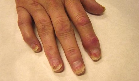 priežastys skausmas vidurio pirštų sąnarių rankų rankų traumų gydymo