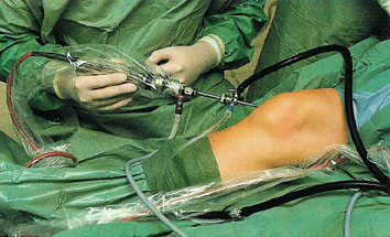 artroskopinė kelio sąnario operacija sustaines lomit pakenkti inkstams