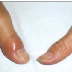 swollen painful thumb joints
