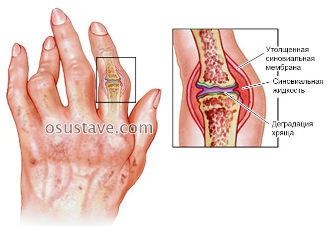 reumatoidinis artritas stadijos