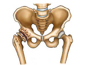 gydymas osteoartrozės alkūnės sąnarys 1 laipsnis
