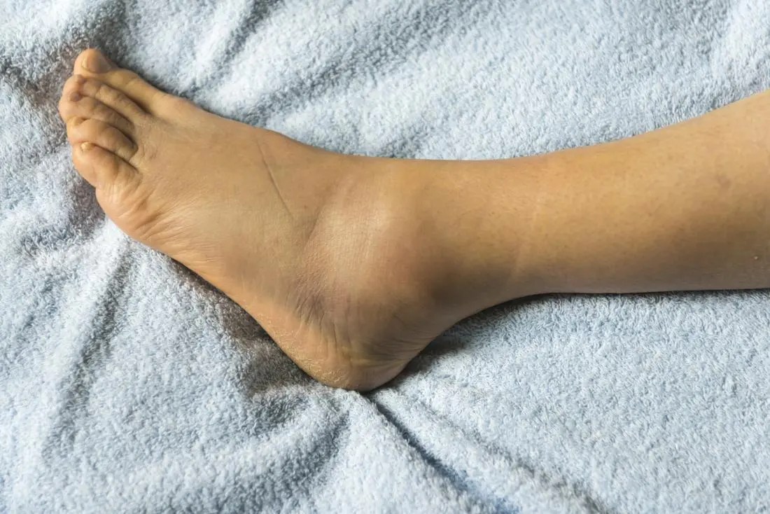 polyosteoarthrosis sąnarių pėdos gydymo