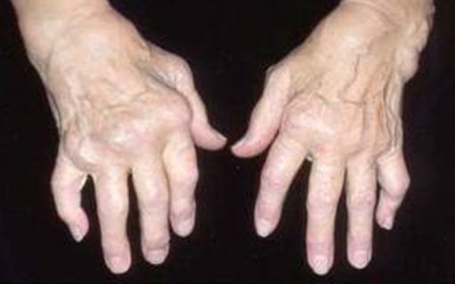 reumatoidinis artritas rankų vyrams