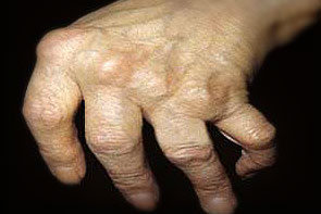 sąnarių nuo falangos riešo rankas skausmas dešinės alkūnės sąnario kai kėlimo sunkumą