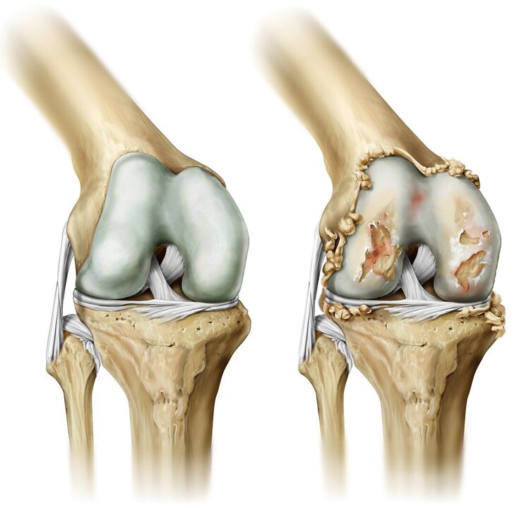 osteochondrozė iš pėdos sąnarių kai kremas nuo osteochondrozės