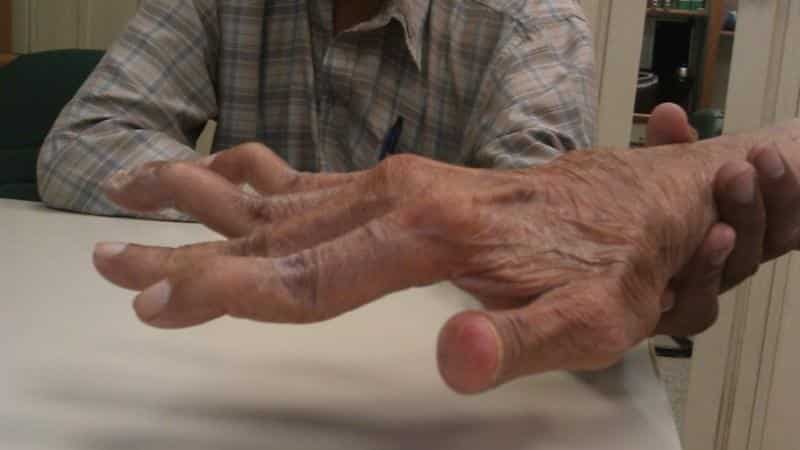 jungtinis ant rankos gydymas gerklės sąnarių apie tepalu rankas