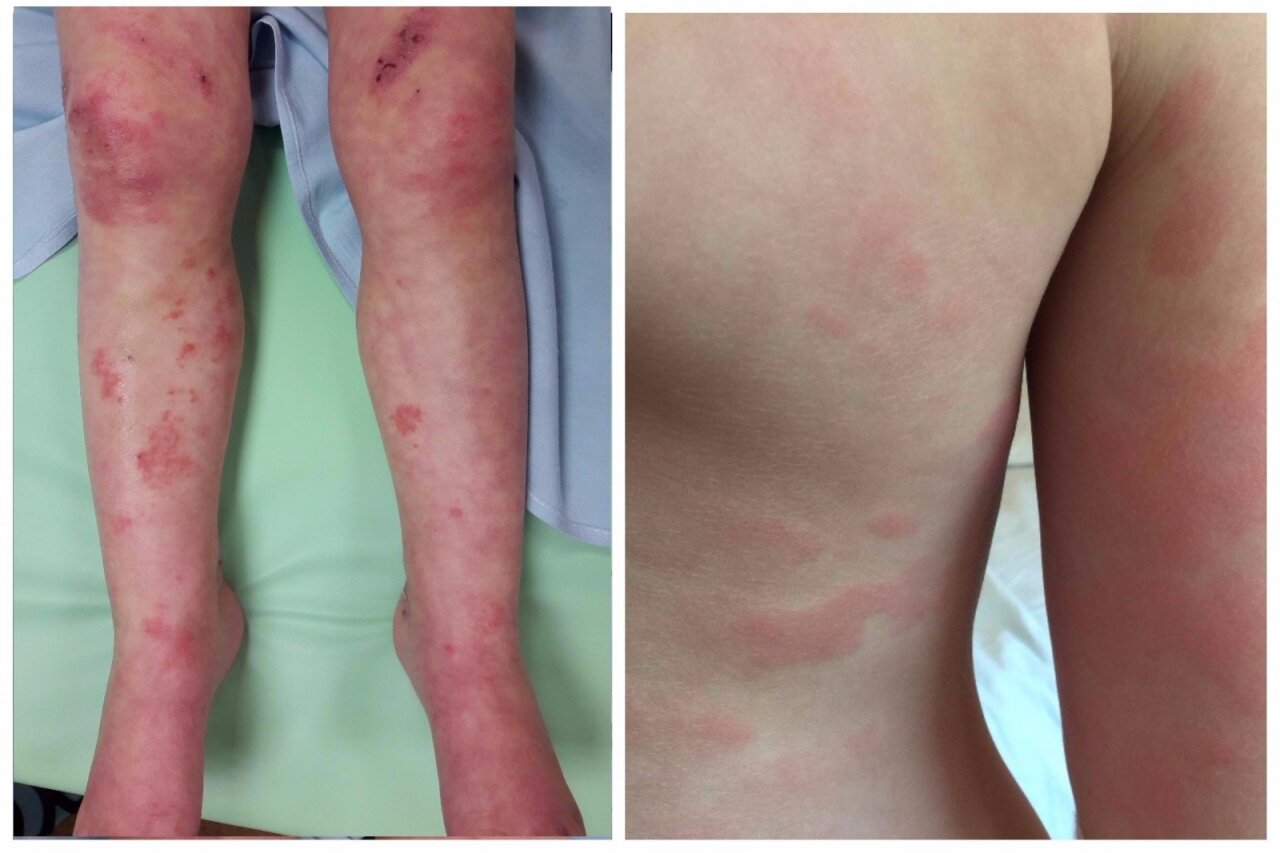 alergijos ir sąnarių liga gydymas šepetėlio sąnario