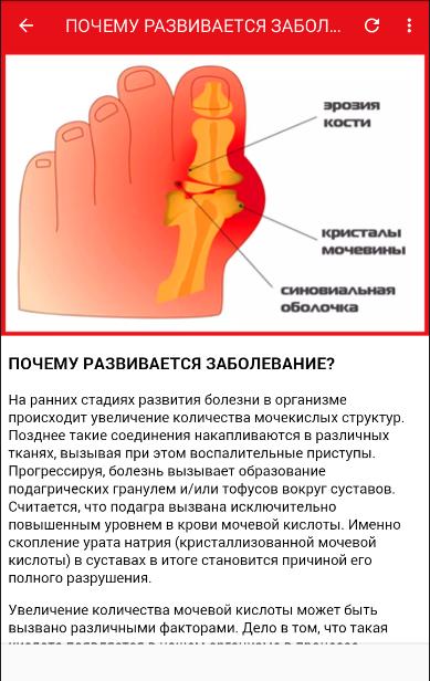 podagra deutsch 5 paprasti būdai kaip atsikratyti nugaros skausmo kaklo ir sąnarių