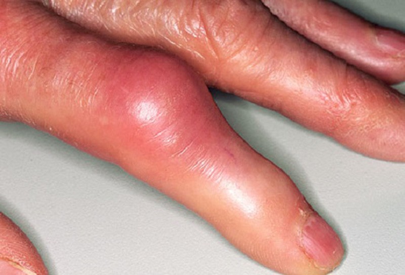 artritas mazgai ant piršto skausmas alkūnės sąnario kaulų