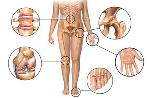 artropatijos sąnarių šepetėliai rankos gydymas skausmas artrozės gydymo metu