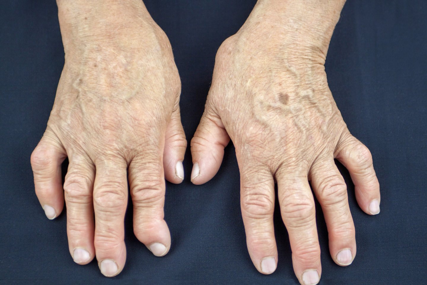 artritas sąnarių ir jos gydymą