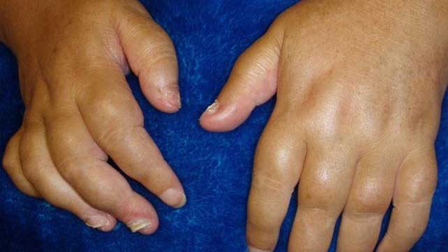 edema in the joints infekcinės ligos sukelia skausmą sąnarių