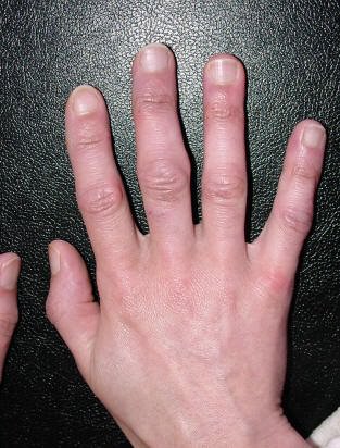 artrito pirštų rankų gydymui