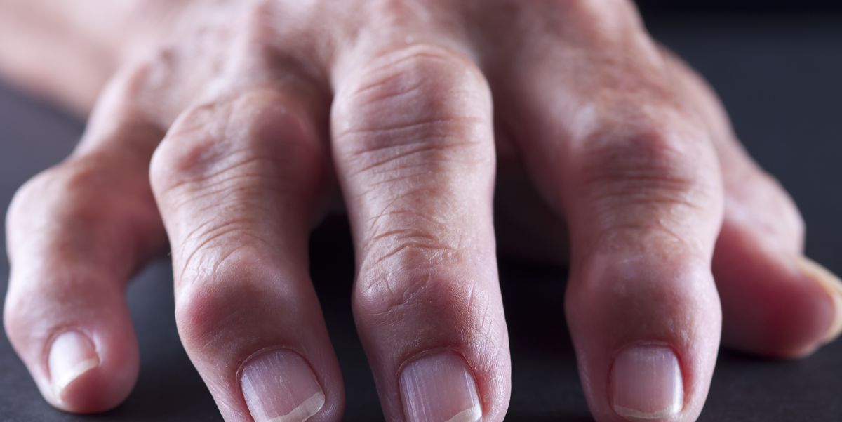 skausmas pirštų šepečiu sąnarių artrozė šepetys rankas ir jos gydymą atsiliepimai