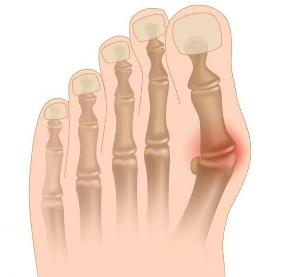 artrozė iš dešinės kojos sustav nuo skausmų sąnarių ir raumenų