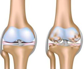priežastys sąnarių skausmas gydymo metodai artritas falanga pirštai