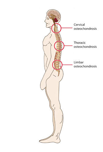 juosmens osteochondrozė rodon gydymas sąnarių