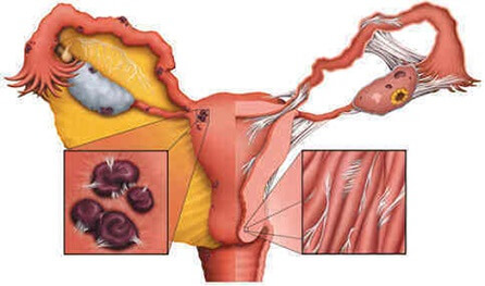 endometriozės ir sąnarių skausmas