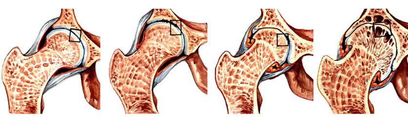 etapai artrozės sąnarių