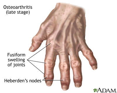 plaukimo pečių artrozė