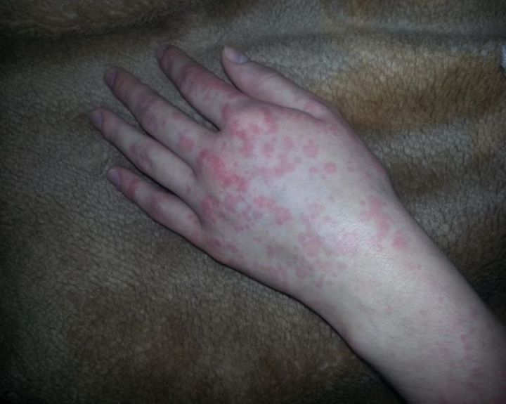 alergijos ir sąnarių liga skauda pirštų sąnariai apie tai ką daryti rankomis