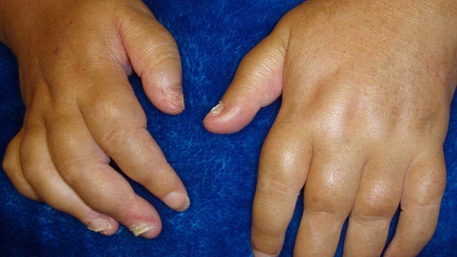 psoriasis artritas simptomai kankina sąnarių skausmas