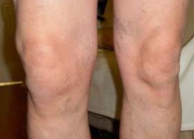 liaudies būdai gydyti artrozės kojas liga artritas rankos