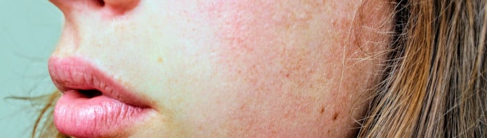 odos paraudimas ir sąnarių skausmas