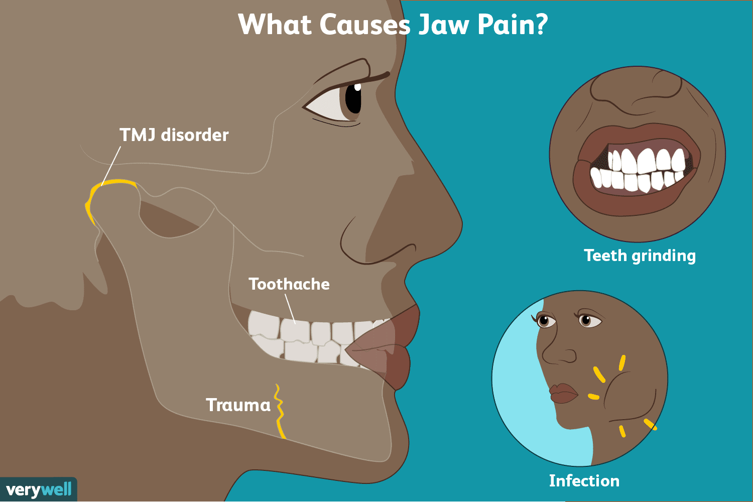 swollen painful jaw joint chondroitino ir gliukozamino vartoti sąnarių