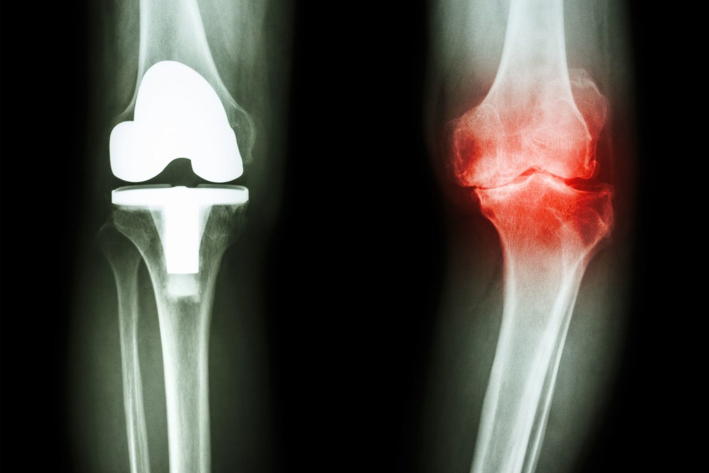 uždegimas iš pirštų sąnarių gydymas osteoartrozės pėdos sąnarių