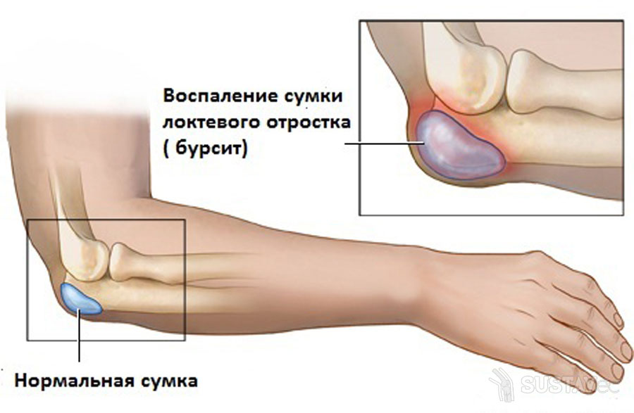 sąnarių uždegimą ant rankų pirštų gydymo