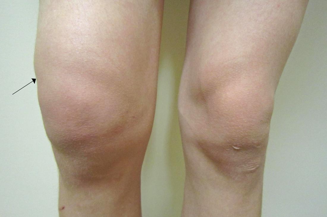 edema in the joints osteochondrose tepalas kainos