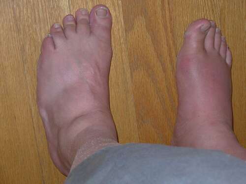 artritas 1 pėdų nutraukti gydymą