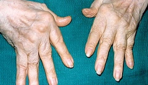 artritas ant pirštų ir skauda