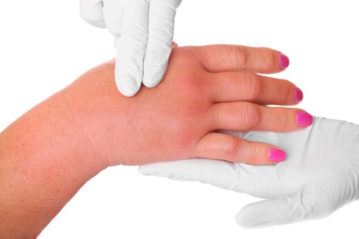 artritas pirštų rankų atsiliepimai