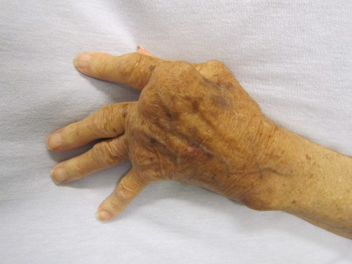susitraukimo gydymas artrozės metu artritas 2 laipsnių teptuku rankoje