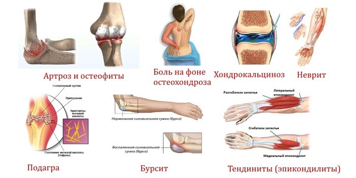 osteochondrozė iš pėdos sąnarių