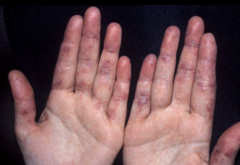 pragariškas skausmas sąnarių ką daryti artritas rankos pirštų