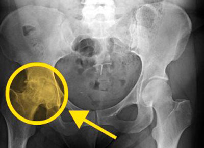 artrozė sustav hip tepalas ir gelių osteochondrozės