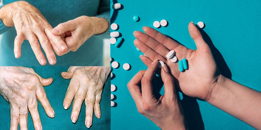 artritas vaistai ranka skauda nykščio sąnario nei padėti
