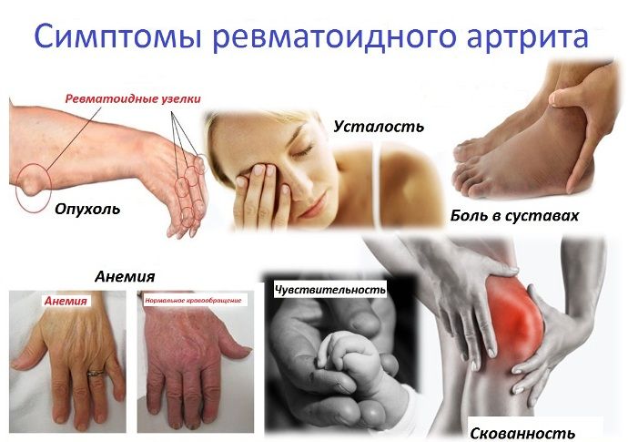 laikykite rankas sąnarius ir sustabdyti priežastis fistulė ant sąnario ir jų gydymas