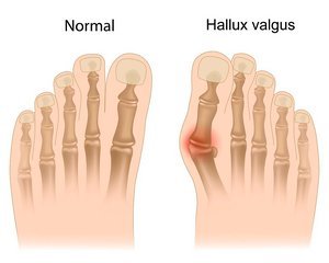 po tramatic artrozė nykščio pėdų gydymui laikykite skausmo priežastis