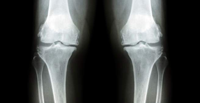 gydymas osteoartrito ir gonartrozės
