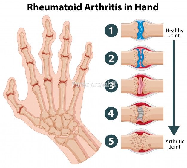ką sąnarį su artrozė atrodo kaip tepalas nuo skausmo sąnariuose ir raumenyse rankų