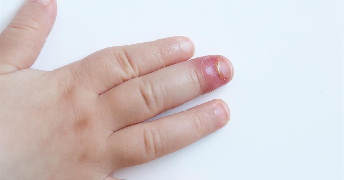 finger sąnarių gerklės priežastys artrozė pirštakaulis pirštai gydymas